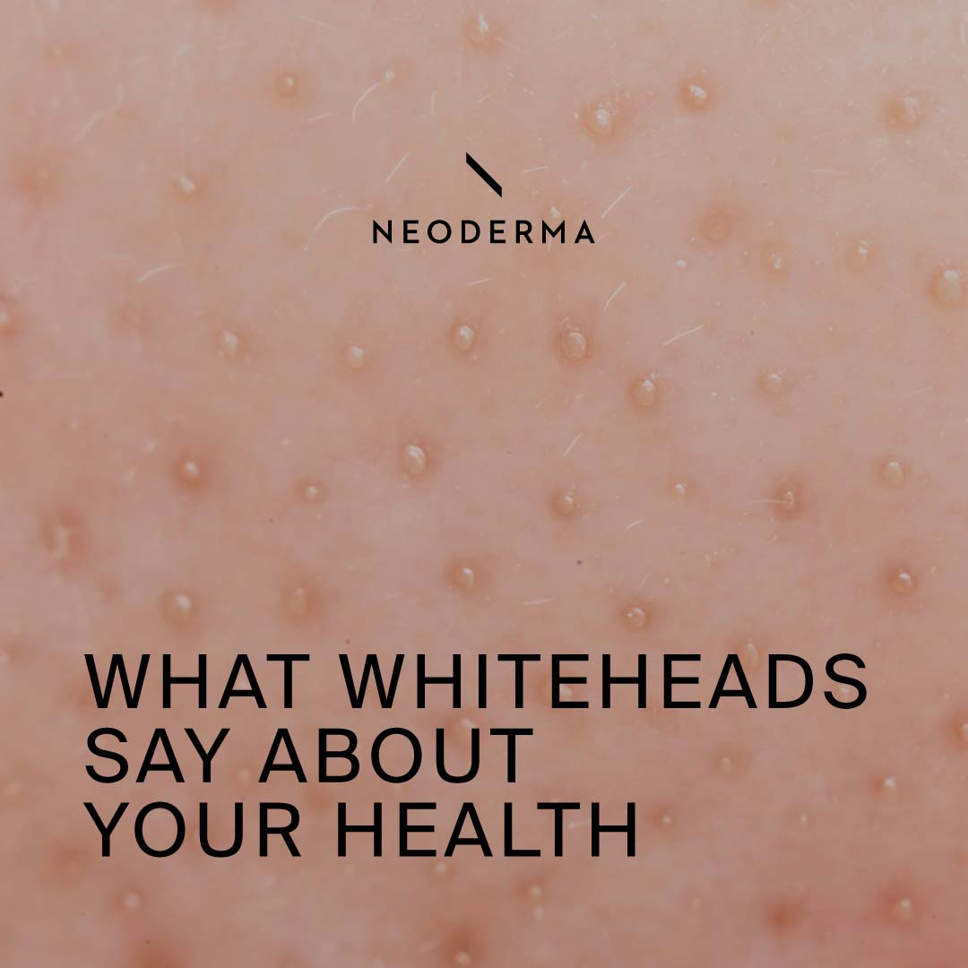 What Whiteheads Say About Your Health