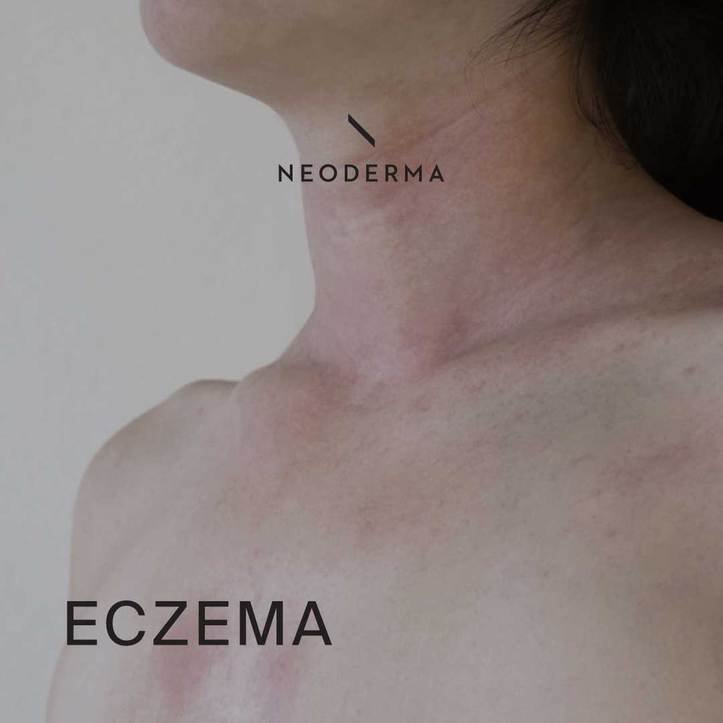 Eczema