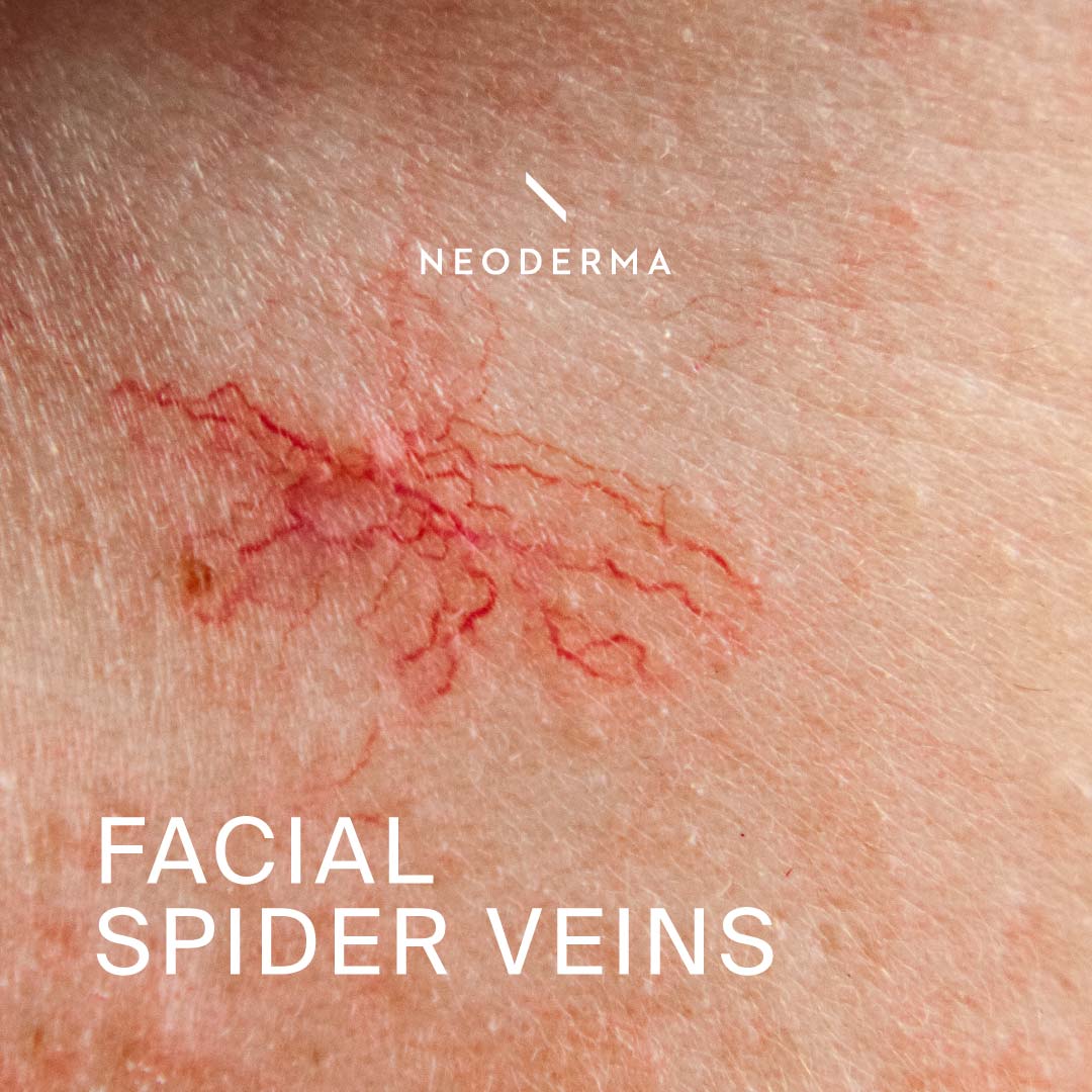 Facial Spider Veins
